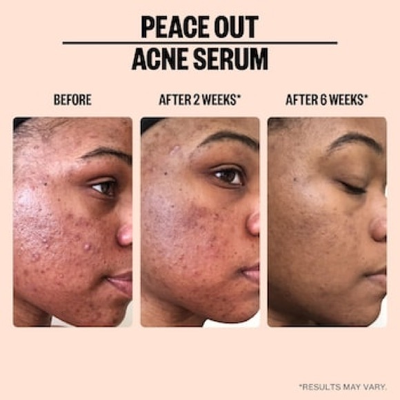 Set peace out solution acne - Picture 3 of 4